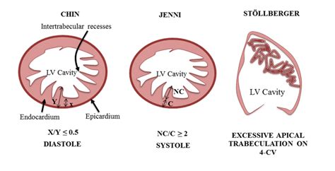 lv noncompaction|lv noncompaction criteria.